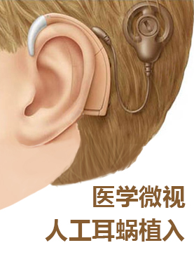 医学微视-人工耳蜗植入